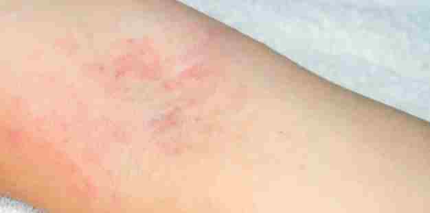 All about Eczema