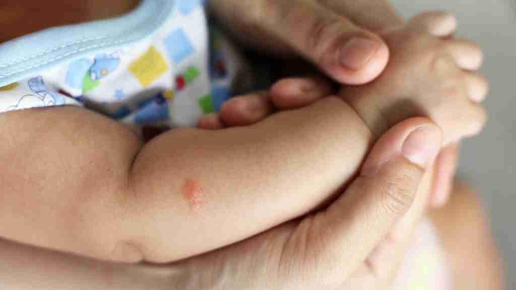 Dealing with ant bite in children