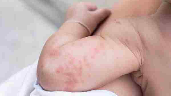Treating baby rashes