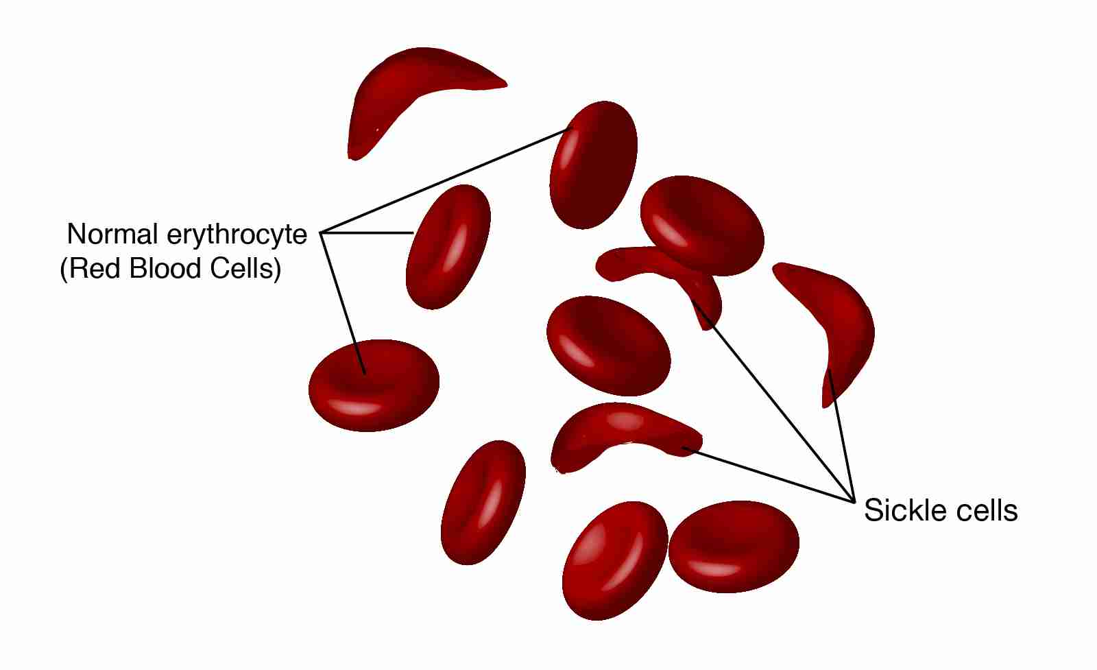 who can get sickle cell anaemia