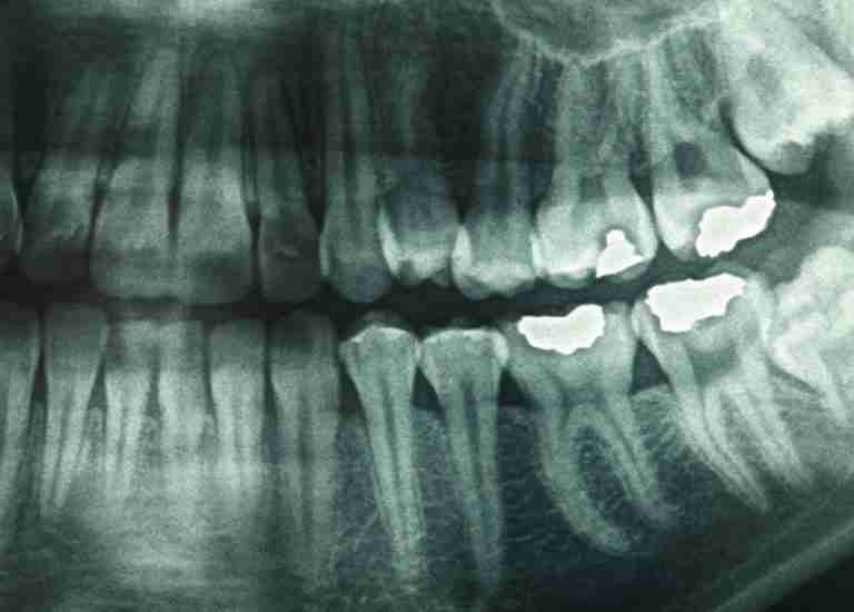 dental x rays for children
