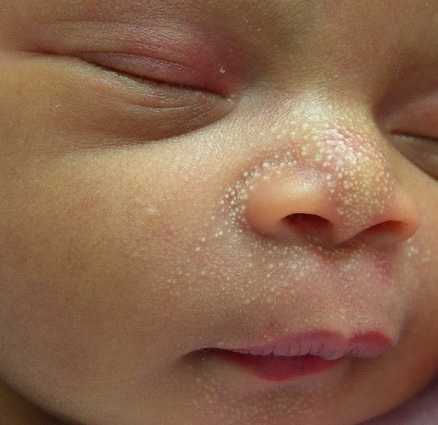 White spots on newborns face